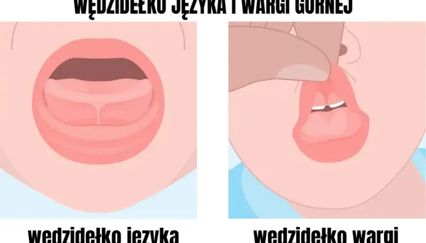Podcięcie wędzidełka: Kiedy ćwiczyć, a kiedy sport? Poradnik